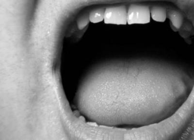 دلیل غلیظ شدن بزاق دهان چیست و چطور درمان می گردد؟